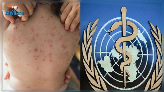 Variole du singe : Plus de 70 000 cas détectés dans le monde, l’OMS appelle à la prudence