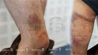 Traces de tortures sur le corps de deux anciens otages Tunisiens en Libye
