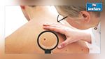 Développement d’une nouvelle molécule contre le cancer de la peau