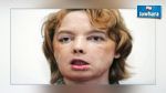 La première greffée du visage dans le monde est morte